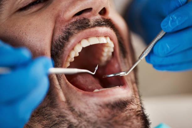 Best Emergency Dentist for Lost Fillings or Crowns in Stepping Stone, CO